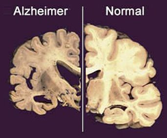 cerebro normal x alzheimer.jpg